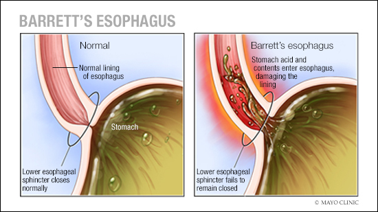 a medical illustration of Barrett's esophagus