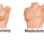 Illustration of lumpectomy and mastectomy, treatments for breast cancer